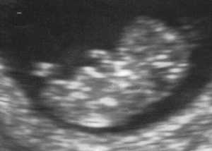 Bean Ultrasound 2B